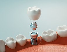 dental implant with abutment and crown being placed into the jaw 