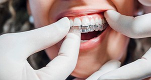 Closeup of hands in white gloves removing Invisalign from patient’s upper arch