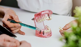 a close-up of a dental bridge