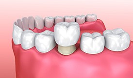 illustration of the process for dental crowns in Framingham