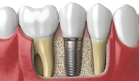 diagram of dental implants in Framingham