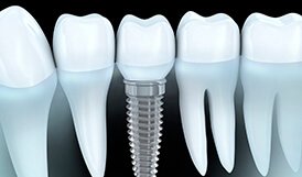 Diagram of dental implants in Framingham