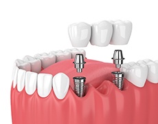 diagram of how dental implants work in Framingham