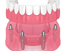 Digital illustration of implant dentures in Framingham 