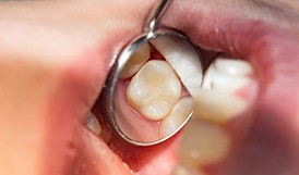 A tooth with a tooth-colored filling
