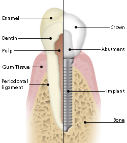 dental implant