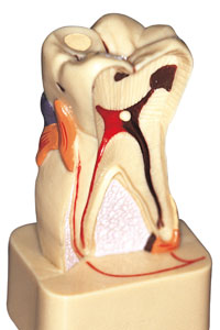 root canal therapy