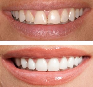 Cosmetic Dentistry changes dull, crooked teeth to a refreshed, natural smile