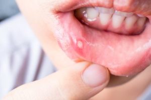 Canker sore on the lower lip