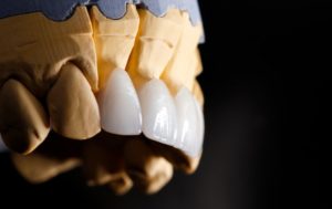 model of porcelain veneers