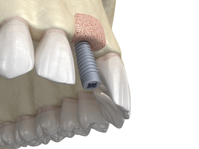 Digital illustration of bone graft and dental implant