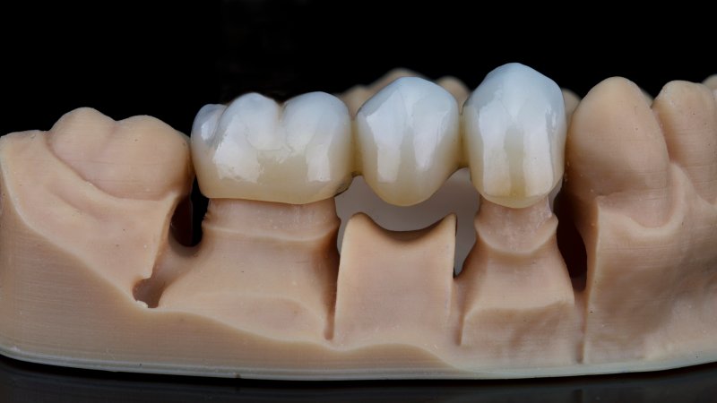 dental bridge 