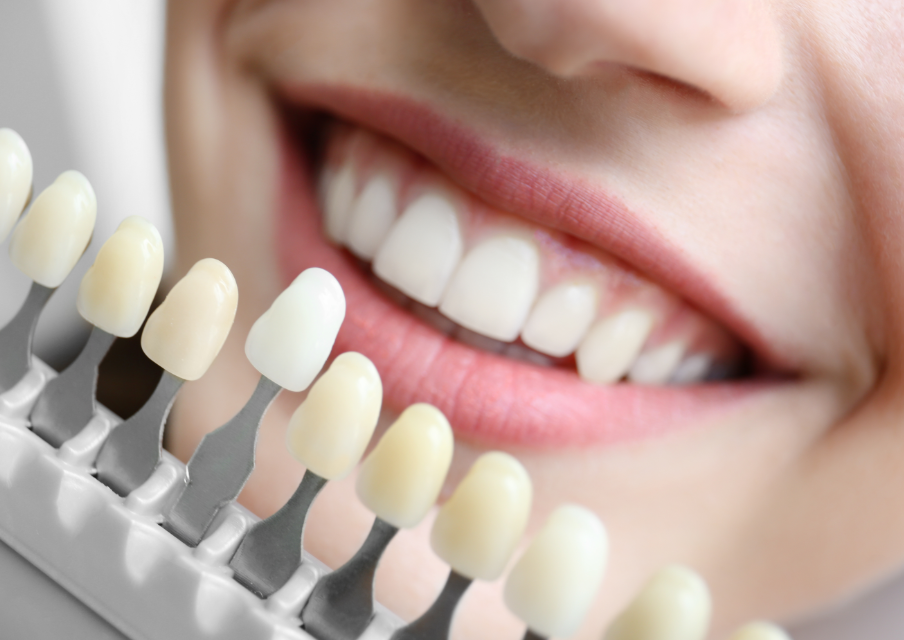 Close up of patient's smile with teeth whitening shade options